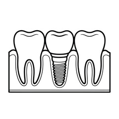 Diagram of a dental implant replacing a missing tooth