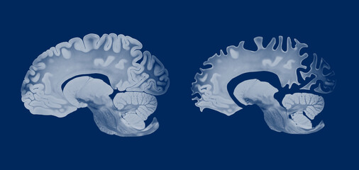 Alzheimer brain comparison in sagittal view showing structural differences between a healthy and affected brain, highlighting cortical atrophy and neurodegeneration on a blue background.