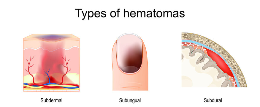Types of Hematomas: Subungual, Subcutaneous, and Subdural