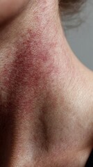Fototapeta premium Close up of red irritated rash on the neck showing inflamed, dry, itchy skin consistent with eczema or allergic dermatitis, medical dermatology symptom and skin condition detail
