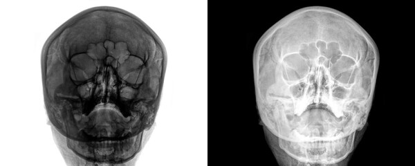 Diagnostic X-ray of PNS in Posteroanterior View Depicting Sinus Cavities and Nasal Structure for...