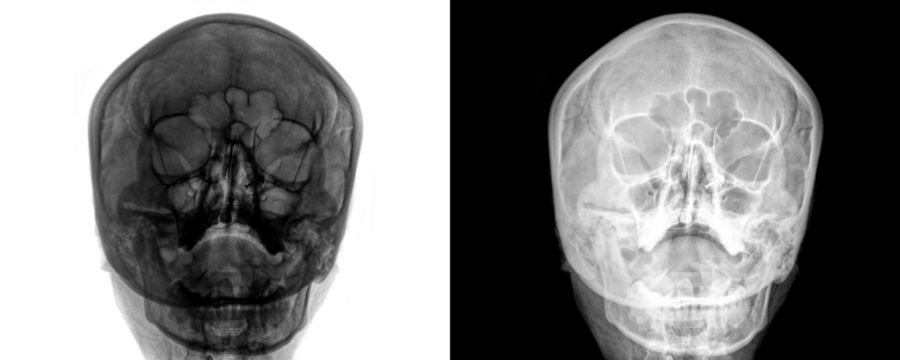 Diagnostic X-ray of PNS in Posteroanterior View Depicting Sinus Cavities and Nasal Structure for Sinus Infection Evaluation Isolated on Transparent Background