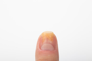 Fungal infection causing yellowing of the nail, on a person with onychomycosis. Close up