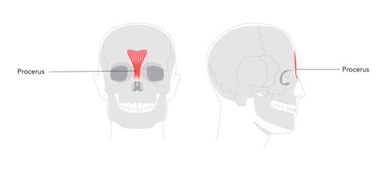 Procerus - Nasal muscle shown in anatomy diagram, responsible for drawing the skin between the eyebrows downward, expressing frowning medical reference and educational illustration
