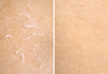 Fototapeta premium Dry skin on one side and moisturized on another, collage before and after