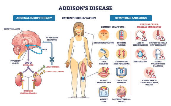 Addisons disease outline illustrates adrenal insufficiency, HPA axis, symptoms, and crisis alerts, key objects, adrenal glands, pituitary-brain, patient figure. Outline diagram