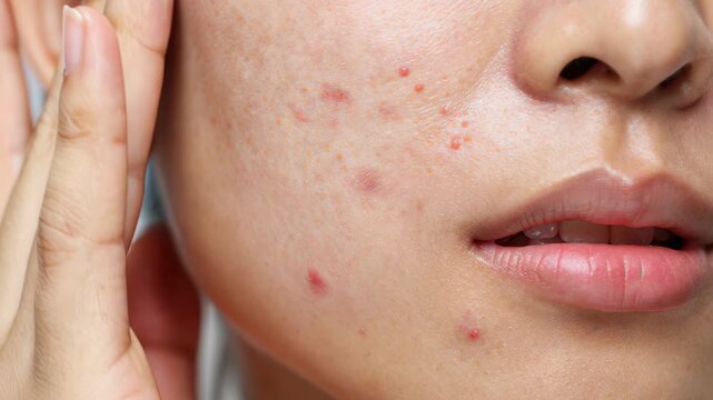 Close up of woman face with acne, pimples, and skin blemishes on cheek.