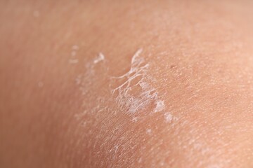 Closeup view of woman with dry skin