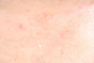 Closeup view of woman with dry skin