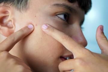 Skin care and adolescence. Preteen boy with a pimple between his fingers