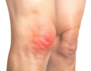 Close-up of a swollen knee with redness, highlighting inflammation and potential injury.