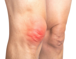 Close-up of a swollen knee with redness, highlighting inflammation and potential injury.
