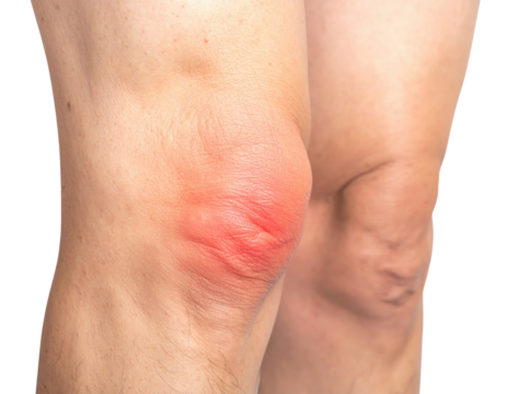 Close-up of a swollen knee with redness, highlighting inflammation and potential injury.