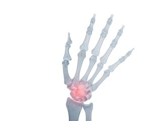 X-ray image of a human hand, highlighting the bones and a red area indicating potential injury or inflammation in the wrist region.