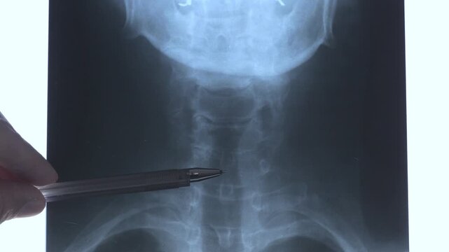 Doctor learning X-ray scan with displacement of intervertebral discs and herniation in the cervical spine.