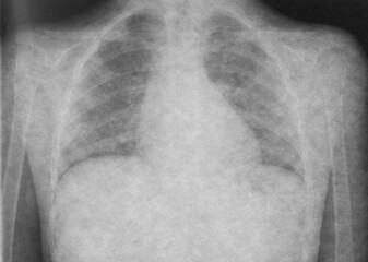 X-ray of the lungs of a sick child. Health examination for suspected bronchitis and pneumonia