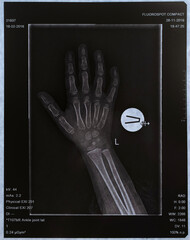 X-ray of a three-year-old child's hand during the examination of bone growth zones in endocrinology