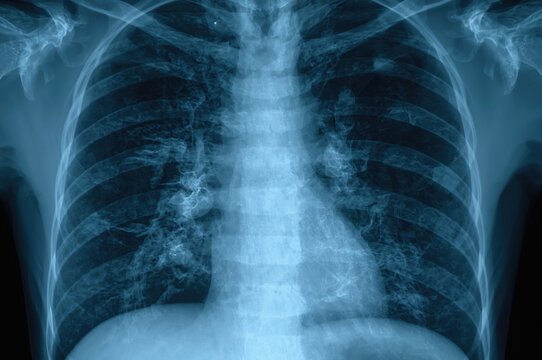 Chest radiograph displaying extensive ground-glass and reticulonodular opacities bilaterally caused by infectious pulmonary diseases including PJP pneumonia, PCP, CMV, and viral infections