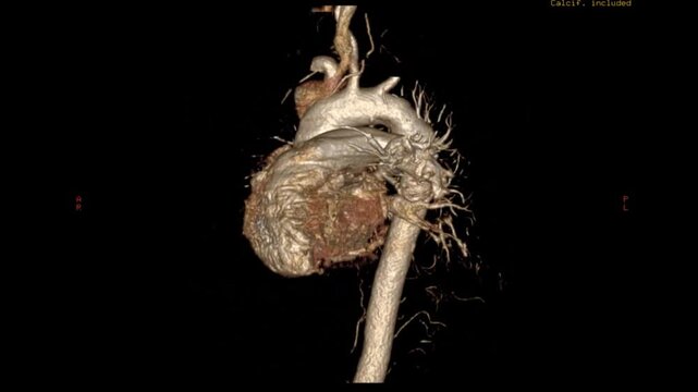 High-resolution PA CT scan reveals detailed posterior&ndash;anterior views of thoracic and abdominal structures. Immerse yourself in advanced medical imaging for precise anatomical insight and diagnostic 