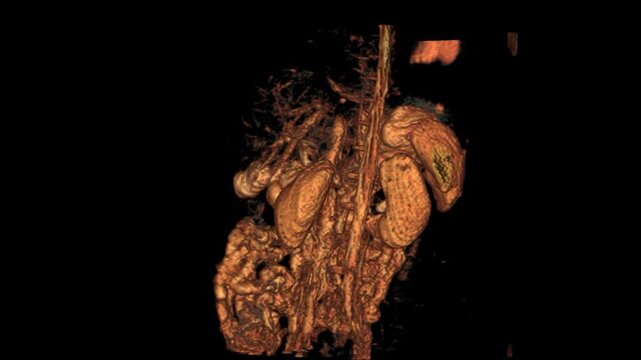 Immersive MRCP VR movie in eT2W-SPAIR coronal view captures detailed biliary and pancreatic duct anatomy in rich contrast. Explore fluid-sensitive imaging that highlights subtle ductal structures  