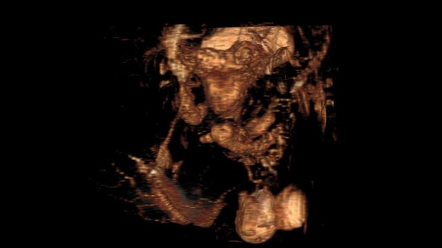 Experience the Fistulogram T2W SPAIR VR Movie featuring high-resolution 3D visualization of vascular structures and fluid dynamics. Ideal for diagnostic interpretation, clinical training, 