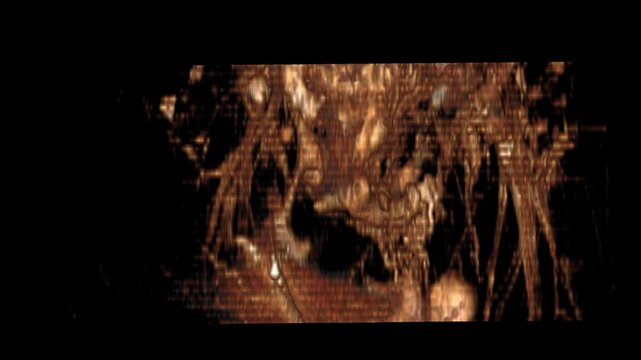 The Fistulogram T2W SPAIR VR Movie showcases advanced 3D imaging of vascular pathways and soft-tissue detail. Perfect for radiology professionals, medical students, and interventional imaging studies.