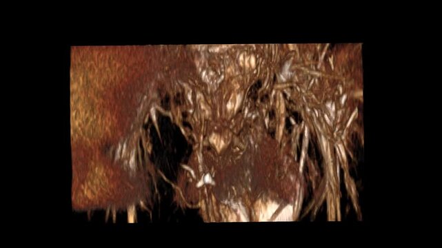 The Fistulogram VISTA VR Movie showcases advanced 3D vascular imaging for fistula evaluation and diagnostic study. Ideal for radiology training, interventional procedures, and medical visualization 