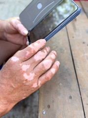 Male hands vitiligo checking messages on phone closeup