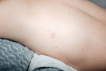 Close-up of suction mark on skin, cupping therapy concept