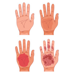 Obraz premium Burn of human hand skin different degree vector illustration showing first aid for fire chemical injury visual symptoms perfect for medical emergency educational materials
