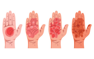 Human hand burn illustration vector showing different degrees ideal for first aid fire or chemical injury visual educational and health safety materials