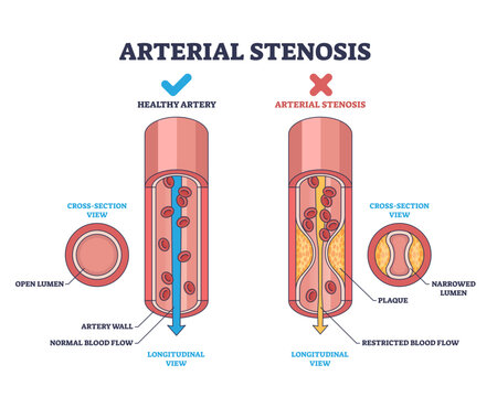 Arterial stenosis is shown by comparing a healthy artery and a narrowed artery with plaque, highlighting restricted blood flow, transparent background.