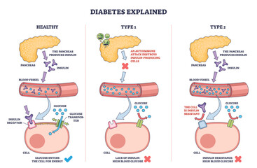 Diabetes types explained with an outline diagram showing pancreas, blood vessel, and cell to illustrate insulin function and glucose uptake, transparent background.