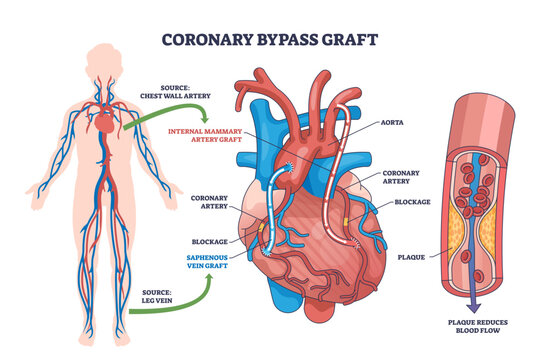Coronary bypass graft surgery is shown with heart, blood vessels, and graft routes to bypass blocked arteries, transparent background.