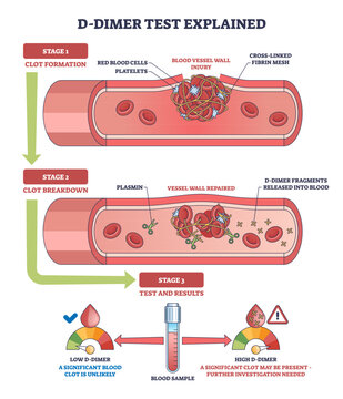 D-dimer test diagram shows blood vessel injury, clot formation, and breakdown with D-dimer fragments in blood, transparent background.