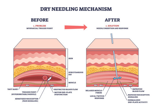 Dry needling mechanism shows needle insertion into muscle trigger point, illustrating blood flow and muscle response, transparent background.