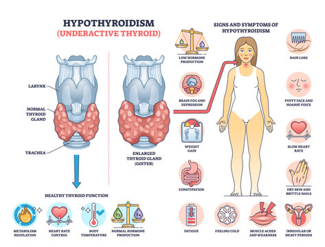 Hypothyroidism is shown with a thyroid gland diagram, symptoms, and hormone imbalance, transparent background.Key objects, thyroid gland, hormone icons, symptom chart.