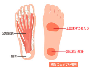 足底筋膜炎　痛みの出やすい場所　足底筋膜　足底腱膜