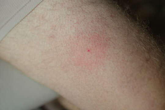 Close-up of human skin with visible insect bite causing redness and irritation. Concept of health, allergy, and dermatology. Symbol of mosquito bite, skin problem, and medical issue related to summer