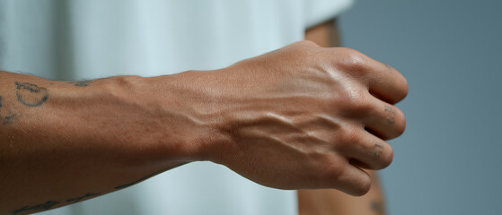 Fototapeta premium Eczema close up skin: Eczema affected arm causes an irritated and uncomfortable feeling that quite visible on skin