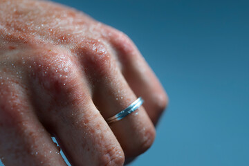 Eczema close up skin: Macro of skin reveals an itchy eczema outbreak, leaving skin looking dry and inflamed, causing discomfort