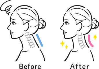 ストレートネックから正常な状態への変化イラスト（女性横顔・ビフォーアフター）