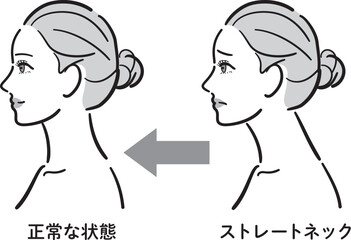 正常な状態とストレートネックの比較イラスト（女性横顔・白黒タイプ）
