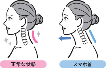 正常な状態とスマホ首の比較イラスト（女性横顔）