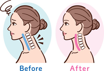 ストレートネックから正常な状態への変化イラスト（女性横顔・ビフォーアフター）