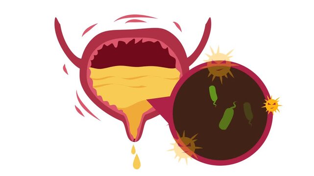 Human Urinary Bladder Disease and Infection Medical Illustration. Urology Health : Overactive Bladder (OAB) and Urinary Tract Inflammation Graphic Animation