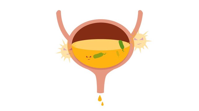 Human Urinary Bladder Disease and Infection Medical Illustration. Urology Health : Overactive Bladder (OAB) and Urinary Tract Inflammation Graphic Animation