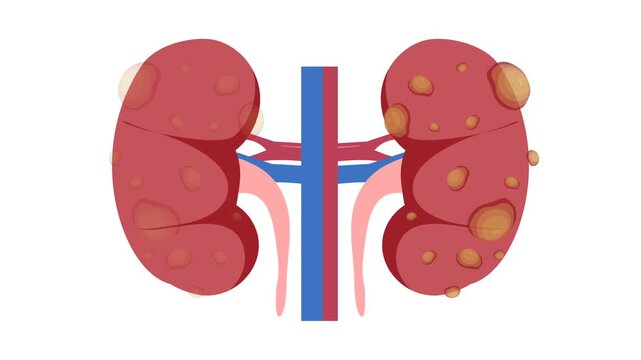 Polycystic kidney illustration animation. World kidney day	