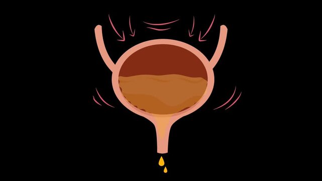 Urinary incontinence illustration animation. Overactive bladder 