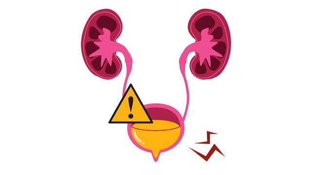 Human Urinary Bladder Disease and Infection Medical Illustration. Urology Health : Overactive Bladder (OAB) and Urinary Tract Inflammation Graphic Animation